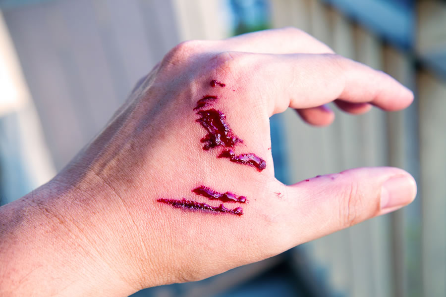 Personal injury claims for Dog bite injuries