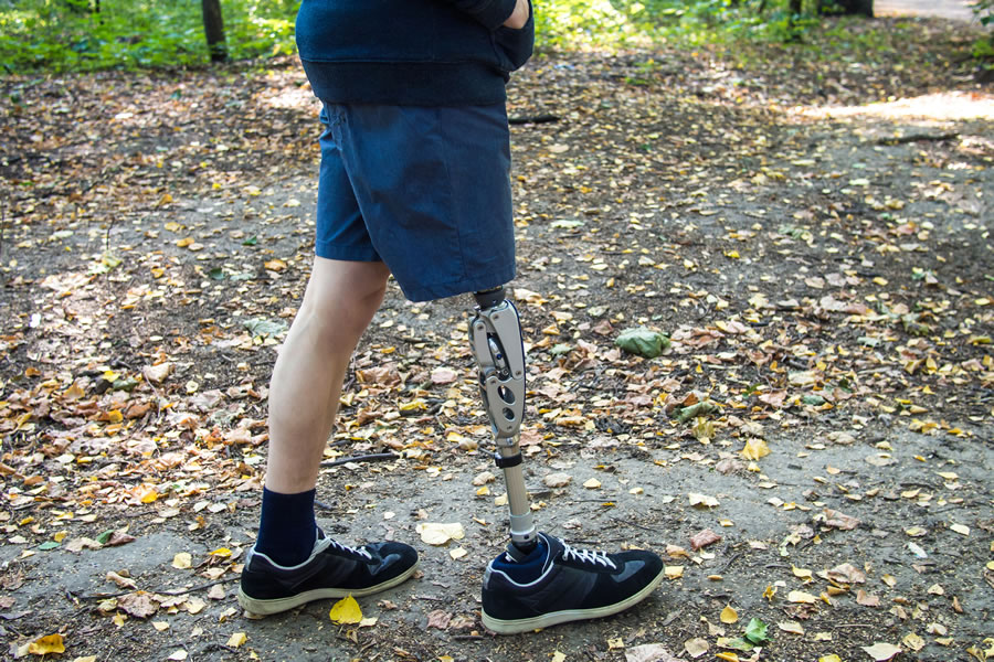 Compensation for Limb loss injuries
