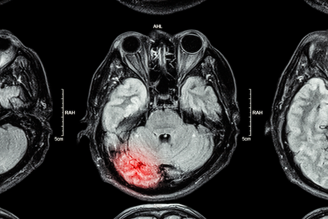 A brain scan image